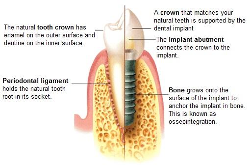 dental-implant-diagram