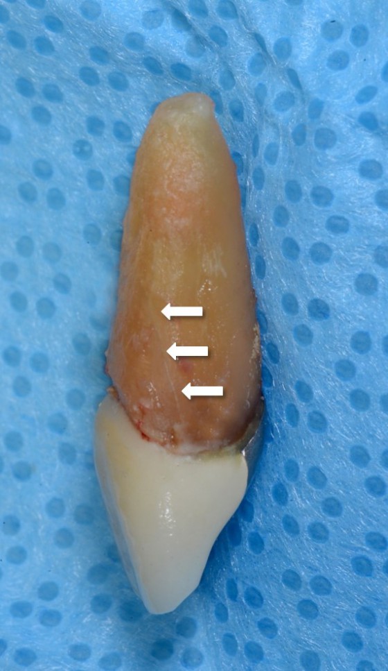 vertical-root-fracture-perio-melbourne